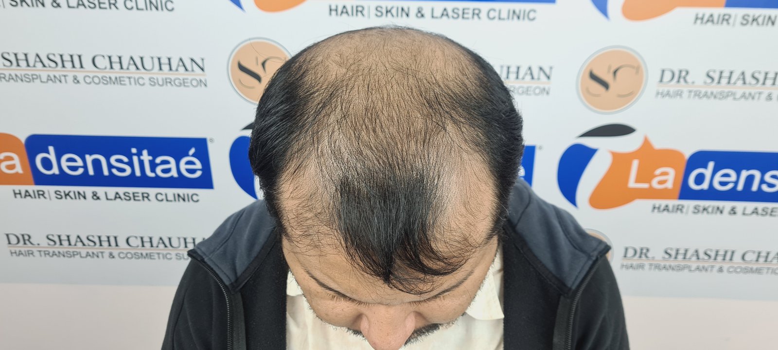 Dr. Bishal Before Hair Transplant